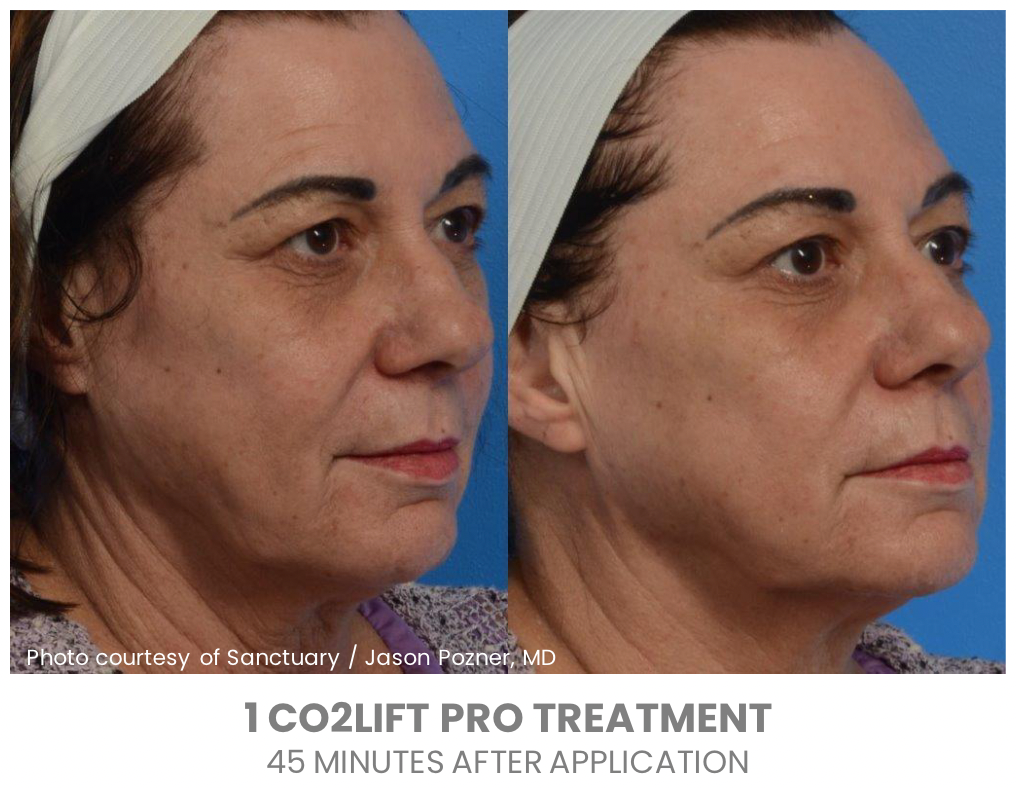 CO2Lift Pro Carboxy Gel Treatment (Single)