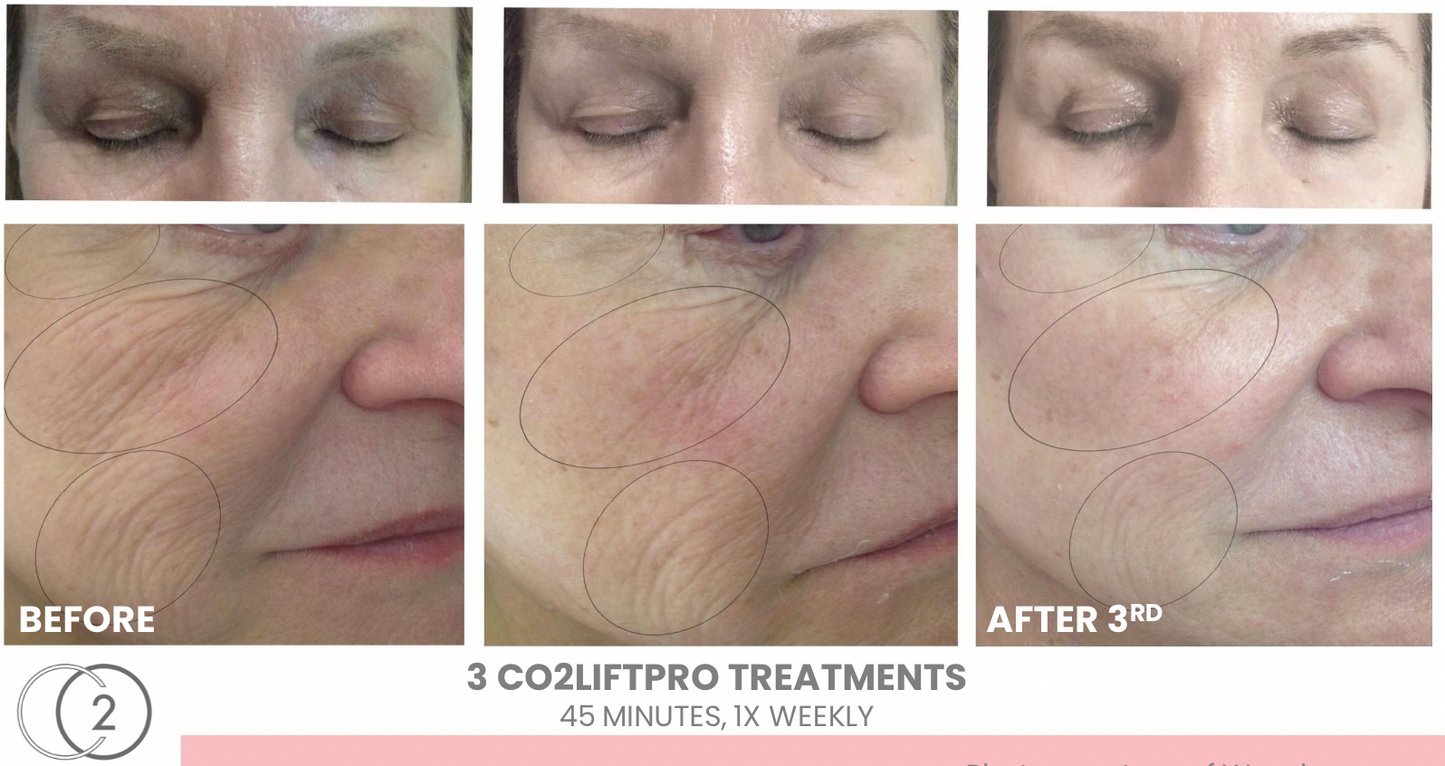 CO2Lift Pro Carboxy Gel Treatment (Single)