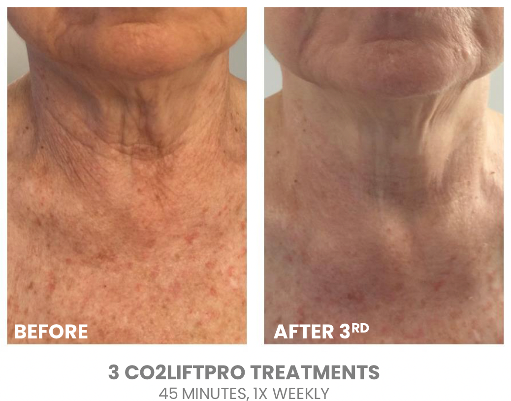 CO2Lift Pro Carboxy Gel Treatment (Single)