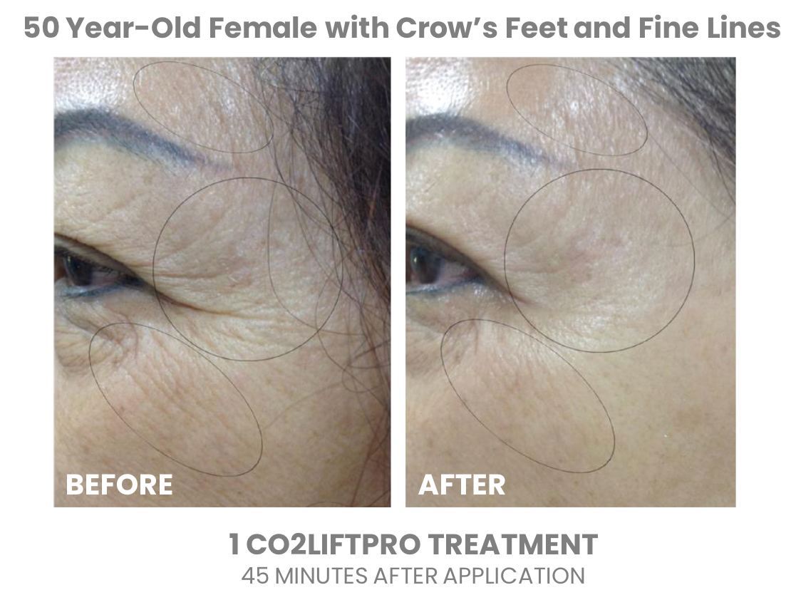 CO2Lift Pro Carboxy Gel Treatment (Single)